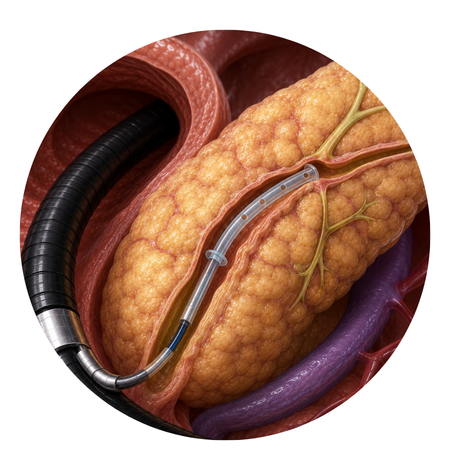 Endoscopic Pancreatic Stenting